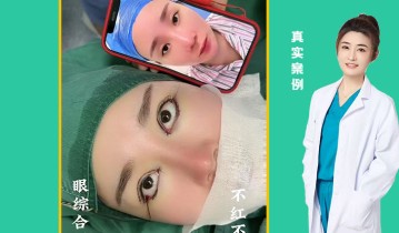 眼综合四项