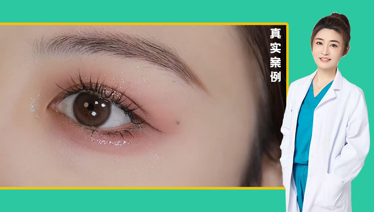 任海燕医生-眼综合双眼皮效果