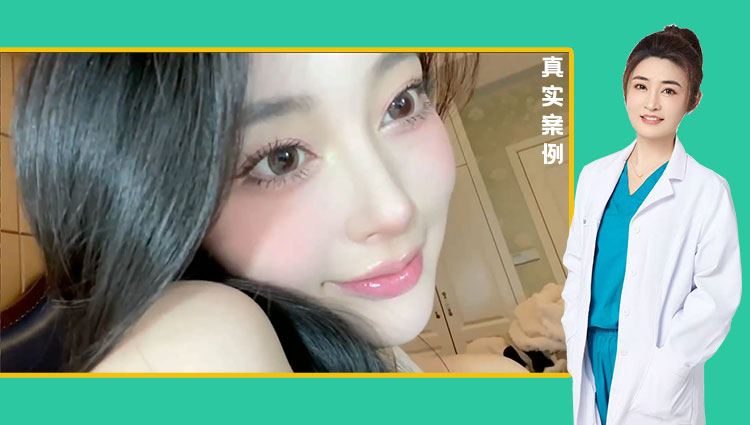 黄金媚眼重睑术效果【2】