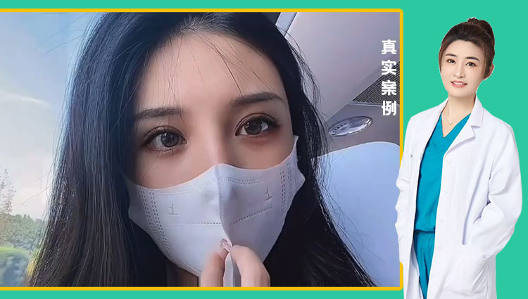 任海燕医生-黄金媚眼重睑术效果