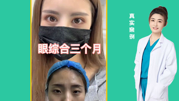 眼综合3个月效果