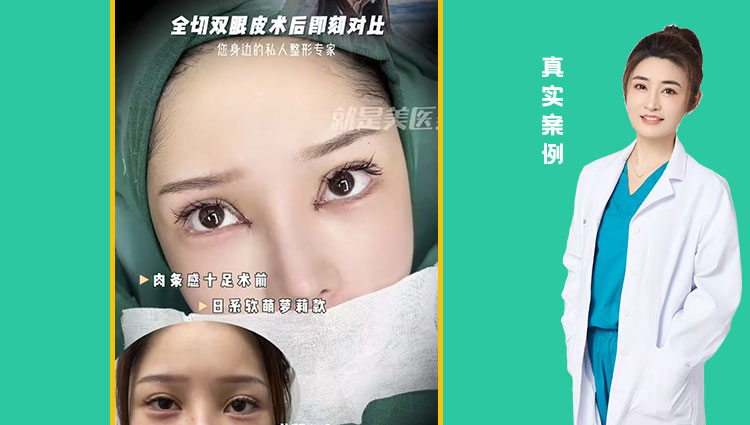 全切双眼皮术后即可对比